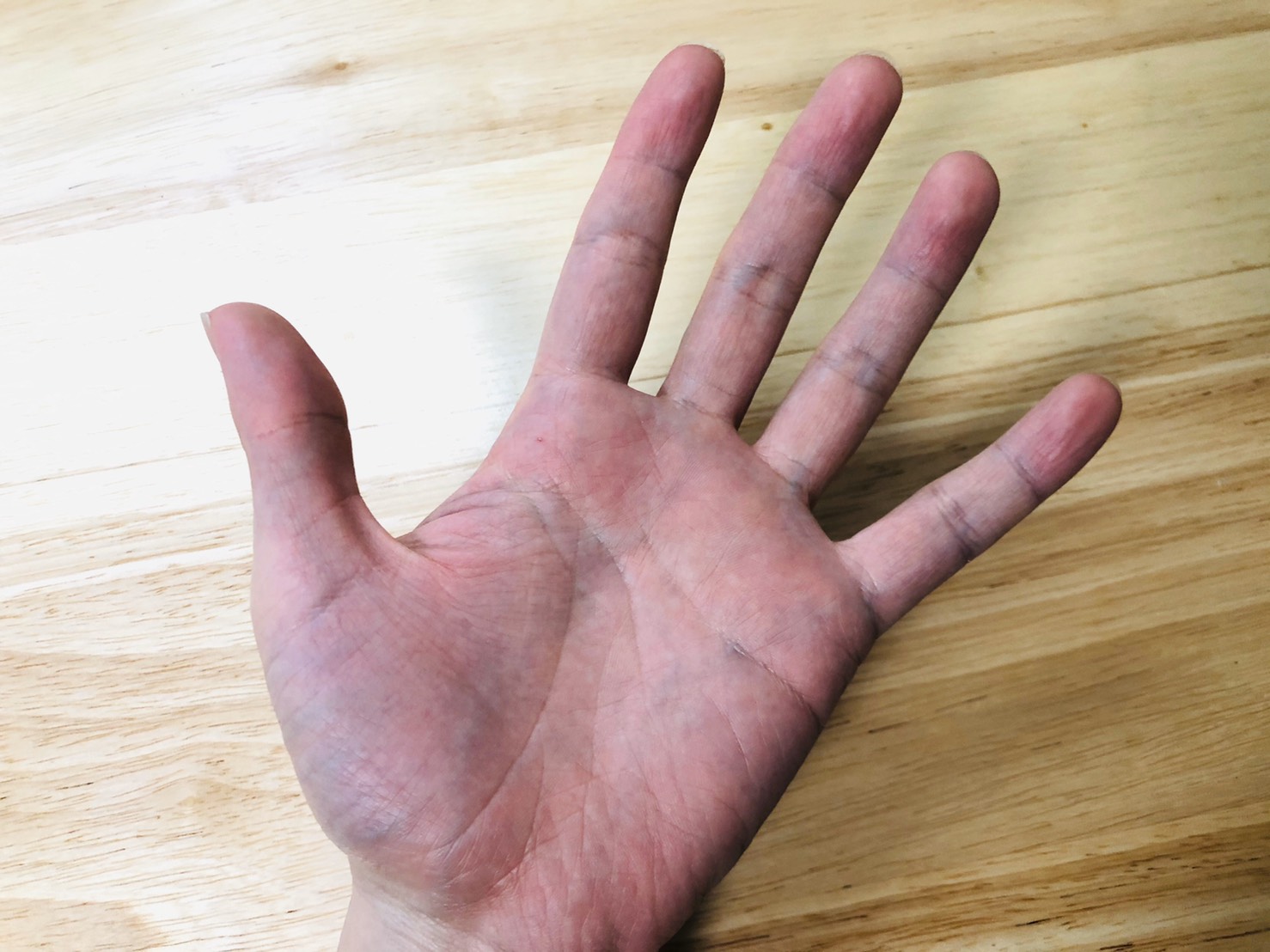 ダーマドライの使い方を解説【手汗が治る期間は？毎日治療が必要？】 | イオントフォレーシス治療で手汗を克服するブログ